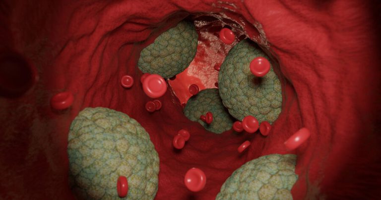 Doktor aterosklerozun ilk əlamətlərindən danışıb