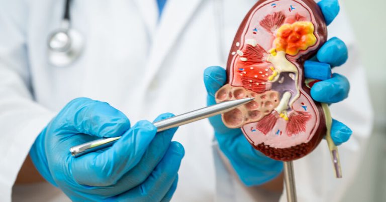 Böyrək daşlarından qoruyan məhsullar müəyyən edilib