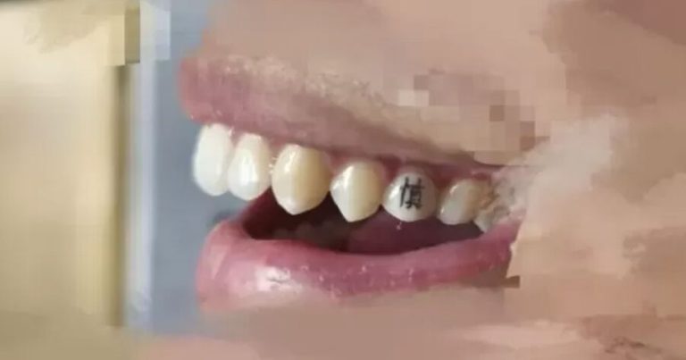 Çində diş döymələri getdikcə populyarlaşır