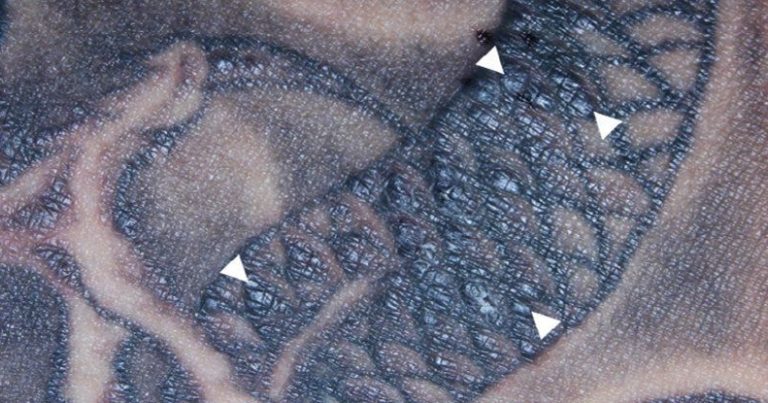 Alimlər döymələrin immun sisteminə təsir etdiyini təsdiqlədi