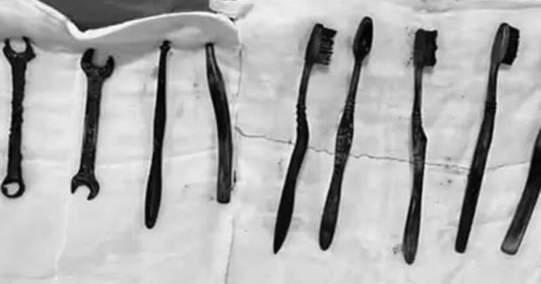 Həkimlər kişinin qarnından yeddi diş fırçası və iki ədəd ingilis açarı çıxarıblar