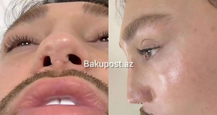 Azərbaycanın ən uğursuz plastik cərrahları: Tanınmış vizajist onları İFŞA etdi – VİDEO