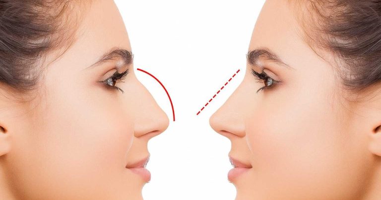 Azərbaycanda bu şəxslərə burun əməliyyatı pulsuz OLDU