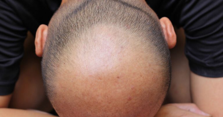 Saç tökülməsi ilə mübarizədə iki effektiv üsul müəyyən edilib