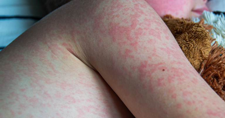 Banqladeşdə qızılca epidemiyası: 1 201 uşaq həyatını itirib
