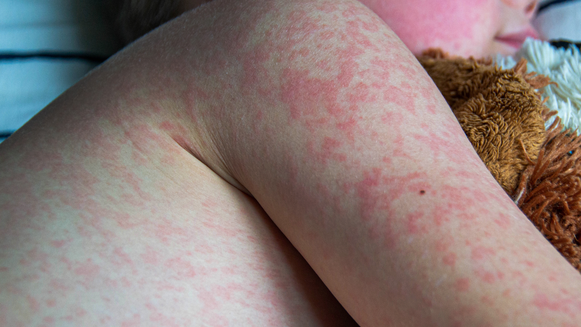 Banqladeşdə qızılca epidemiyası: 1 201 uşaq həyatını itirib xəbəri üçün şəkil